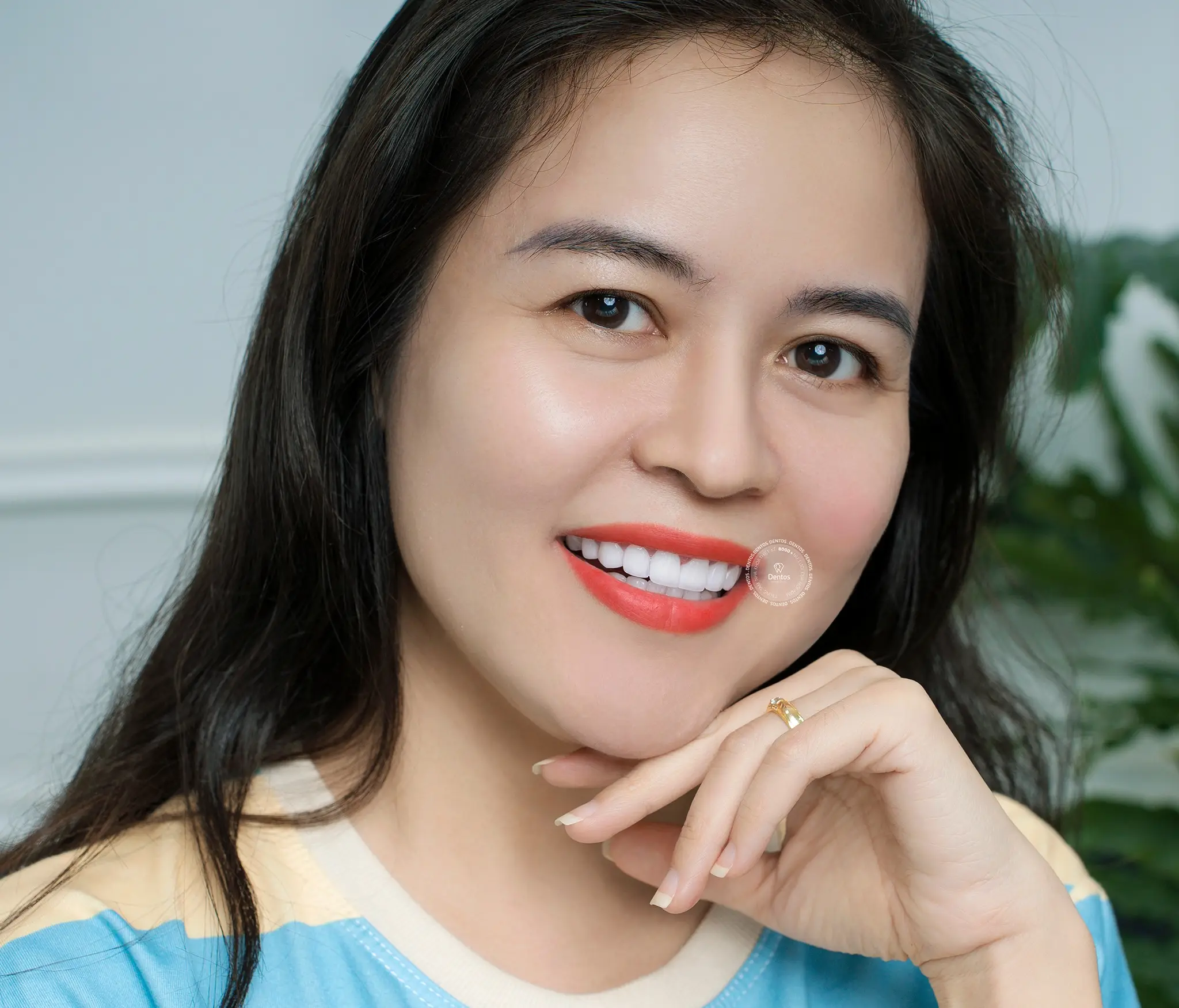 Răng sứ DDBio có tốt không, cách nhận biết & giá bao nhiêu?